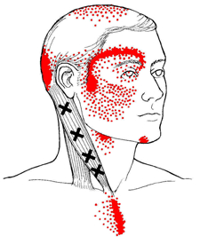 Trigger Point : Tensions nuque, migraines,...